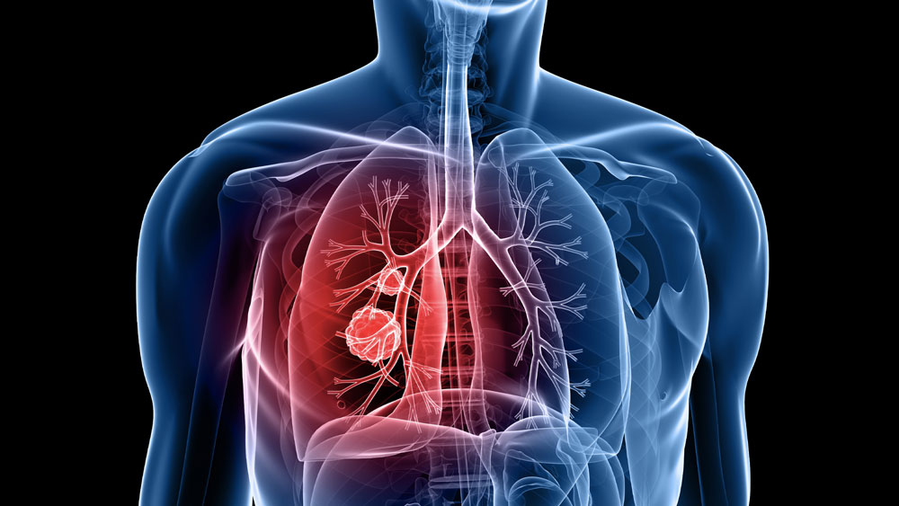 Vital capacity and COPD: the swedish CardioPulmonary bioImage study (sCaPIs)