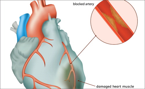 Myocardial Infarction with Nonobstructive Coronary Arteries (MINOCA): A Review of the Current Position